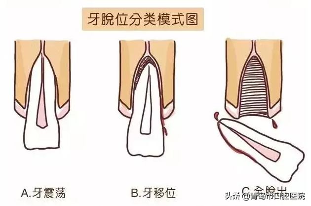 小孩摔断了乳牙需要拔掉吗,换过牙以后儿童摔断牙齿怎么处理