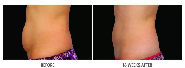 酷塑冷冻溶脂副作用是什么样的,酷塑冷冻溶脂的真实经历对比