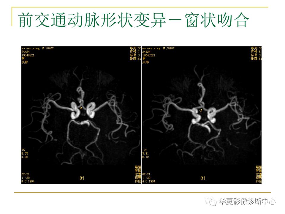 中国人脑立体定向mri应用解剖图谱,脑mri示意图