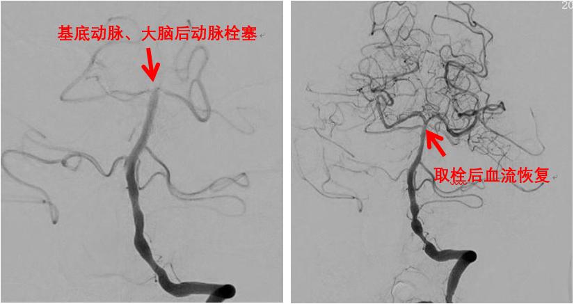介入不放支架可以吗,介入放支架治标不治本