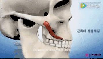 哪个明星做了颧骨内推,颧骨内推明星前后对比