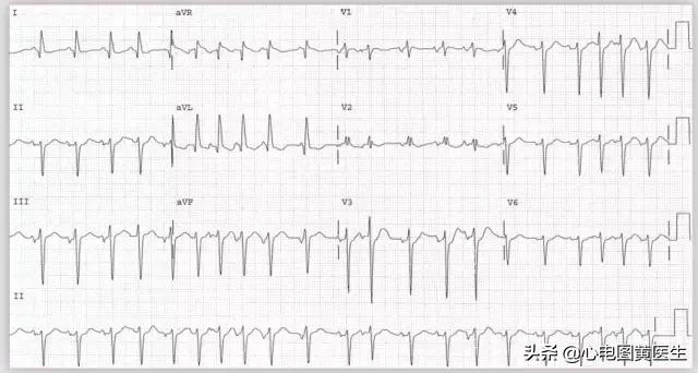 多形性室性心动过速心电图图片,心电图临床意义及正常值