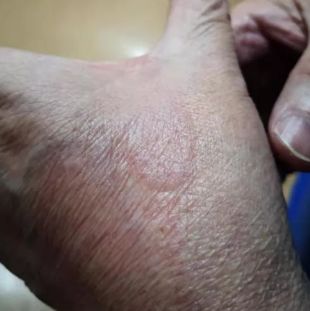 男孩眼睛被硫酸伤到,男孩被化学药水弄瞎眼睛