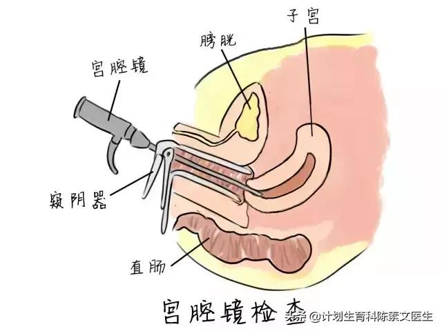 宫镜是宫腔镜吗,宫腔镜和宫腹腔镜的区别