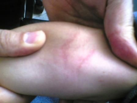 猩红热是疹子先出现还是发烧,猩红热出疹子后体温低烧