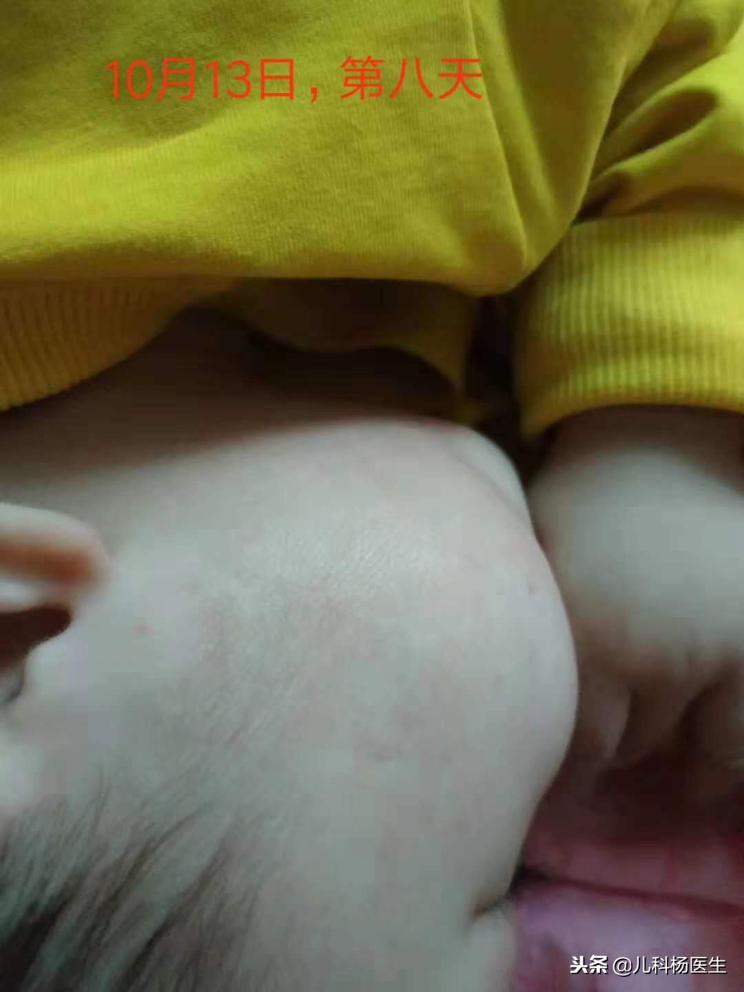 宝宝湿疹涂了炉甘石又严重了,宝宝湿疹抹了药更严重了