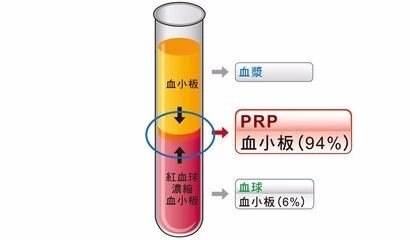 网球肘肩周炎腱鞘炎滑膜炎,富血小板血浆疗法适合网球肘吗