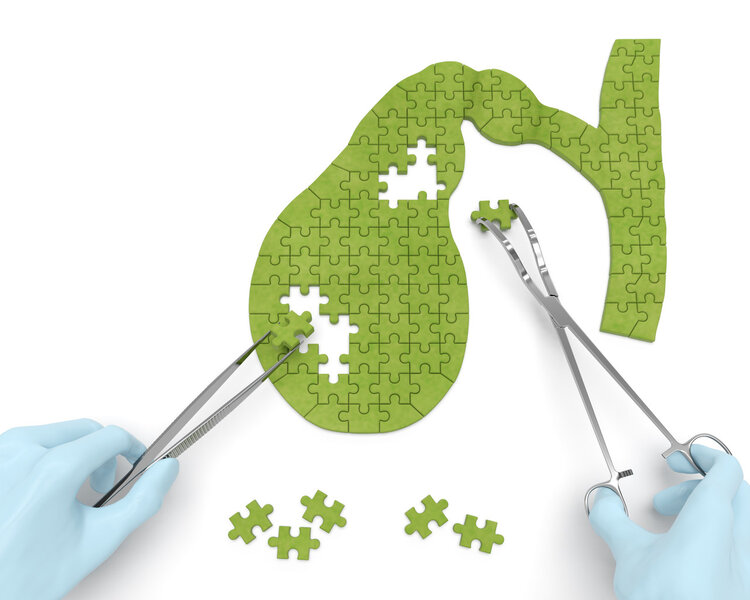 胆囊息肉0.3*0.2严重吗需要切除吗,胆囊息肉1.5厘米必须手术切除吗