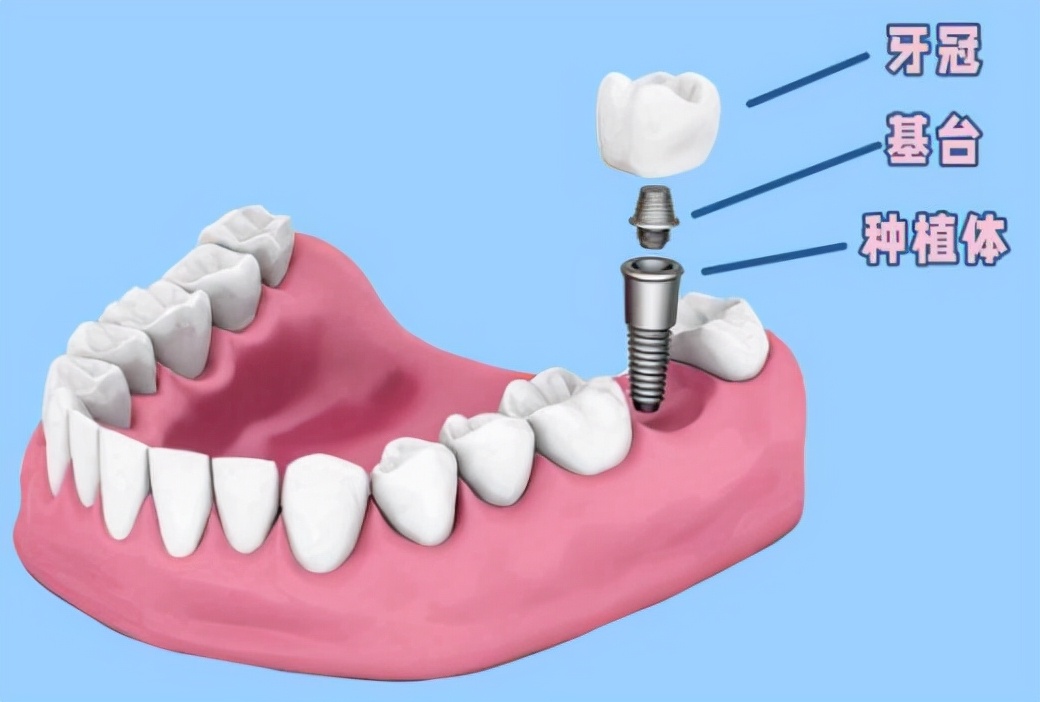 种植牙与假牙的区别是什么,种植牙vs假牙3大牙齿修复方式对比
