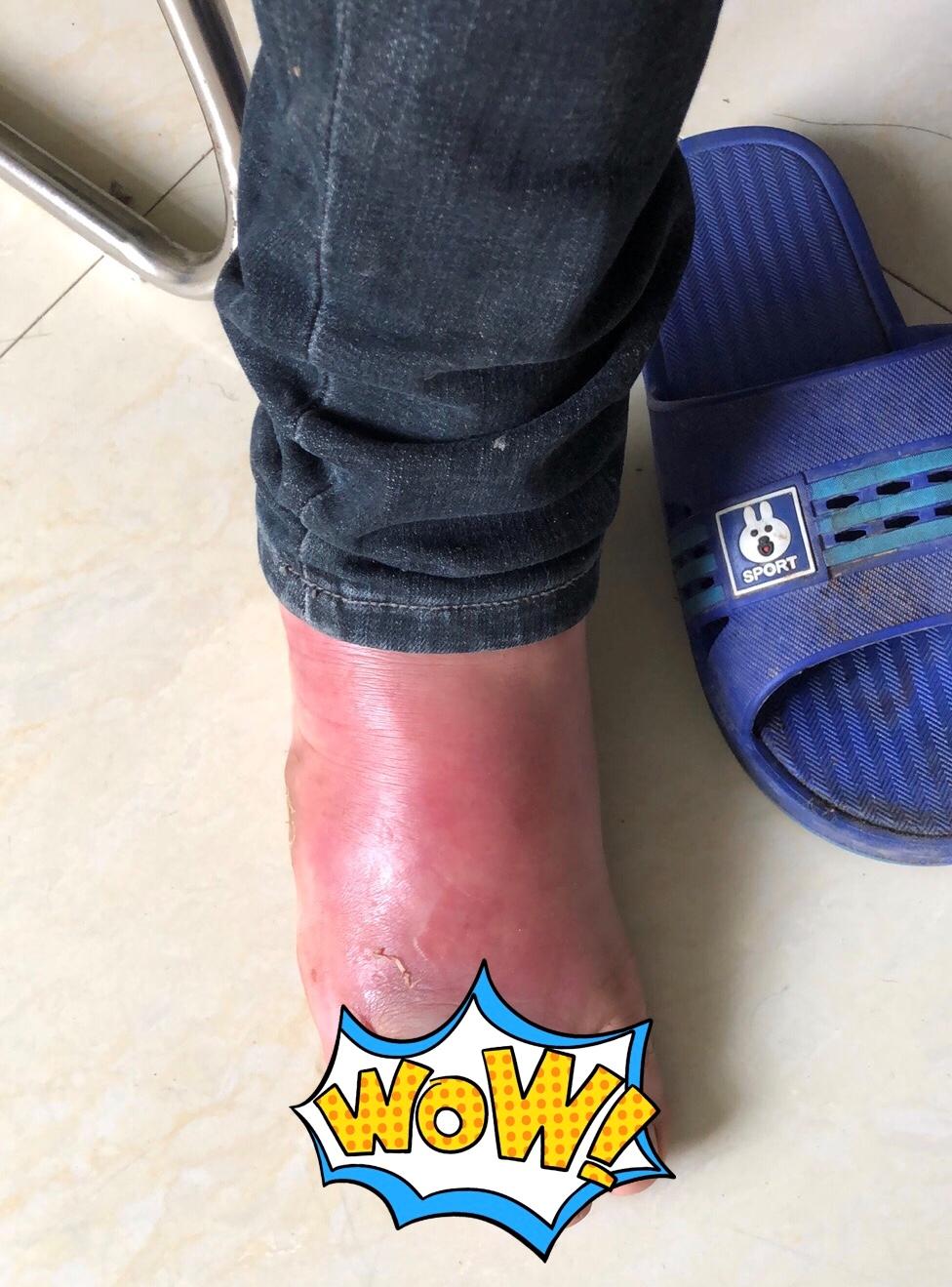 糖尿病足破溃如何处理,糖尿病患者出现脚部溃烂后果怎样