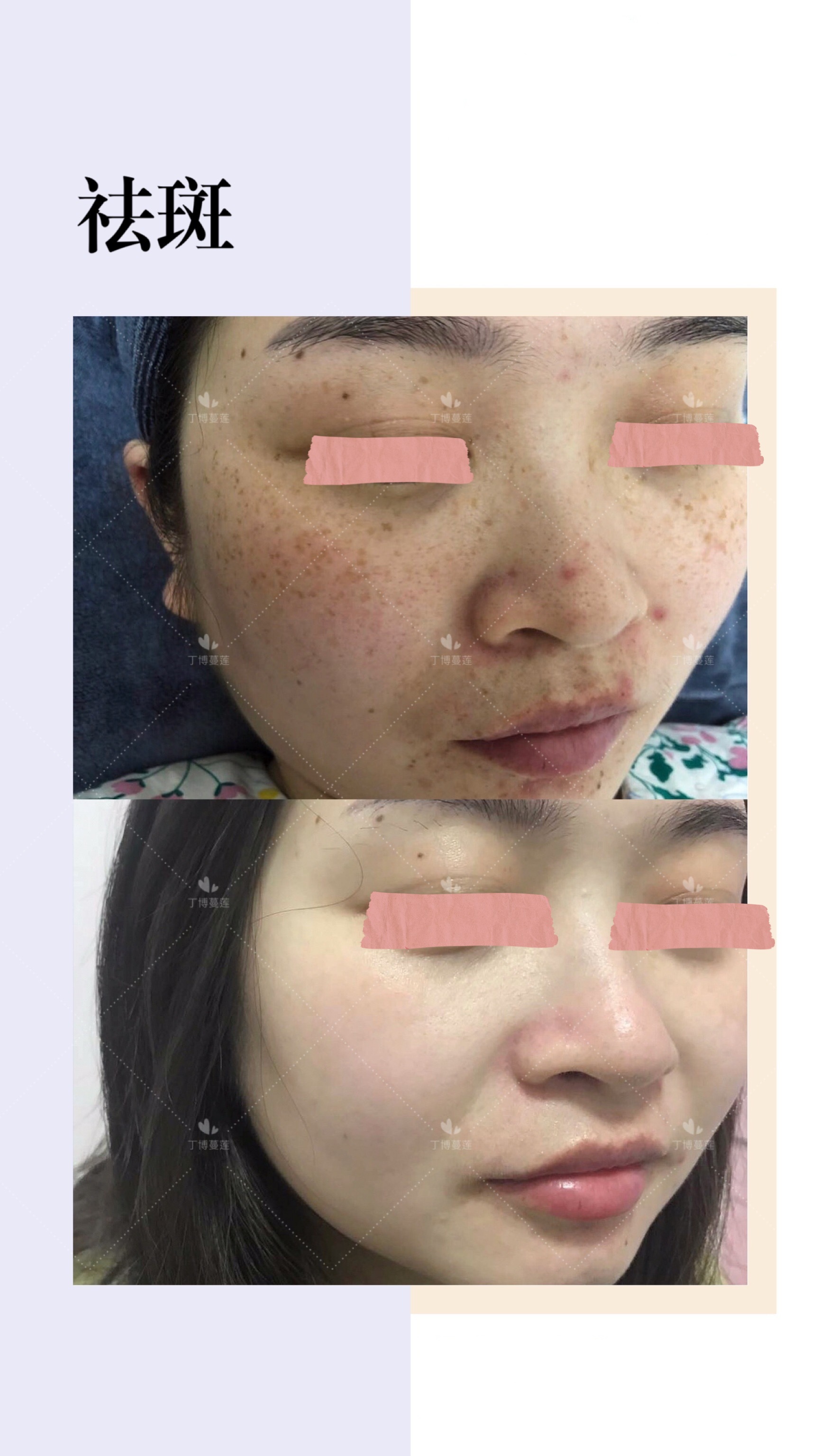 雀斑祛斑最简单有效方法,雀斑祛斑最有效方法真实测评