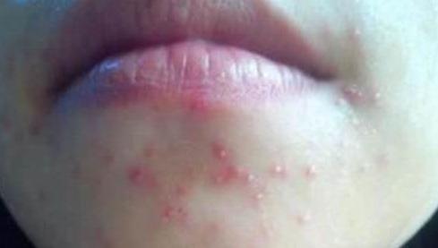 下巴反复长痘闭口粉刺用什么药膏,下巴粉刺痘痘反反复复怎么调理