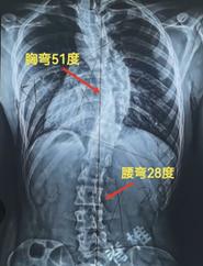 18岁少女脊柱严重侧弯元凶,16岁女童脊柱侧弯