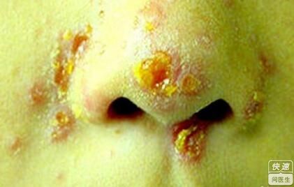 脓疱疮的症状,脓疱疮如何治疗呢其病因是什么