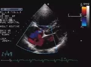 超声检查和b超检查哪个准确,超声b超能检查出什么