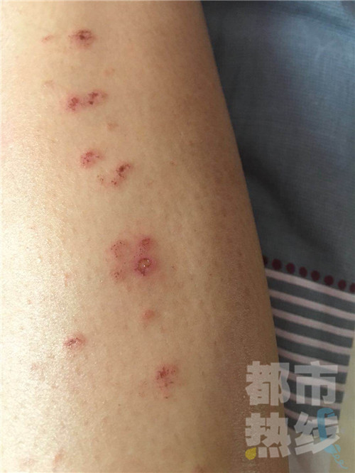 面部激光脱毛后毛发变多,女生激光脱唇毛后色素沉着