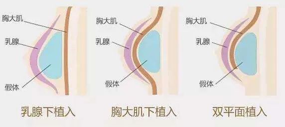 丰胸最新技术,最新丰胸秘籍不反弹