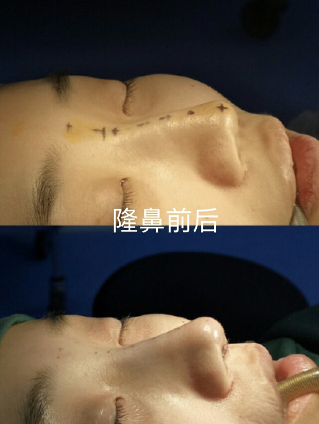 隆鼻好多年有鼻炎怎么办呢,有鼻炎的人做了隆鼻会怎样