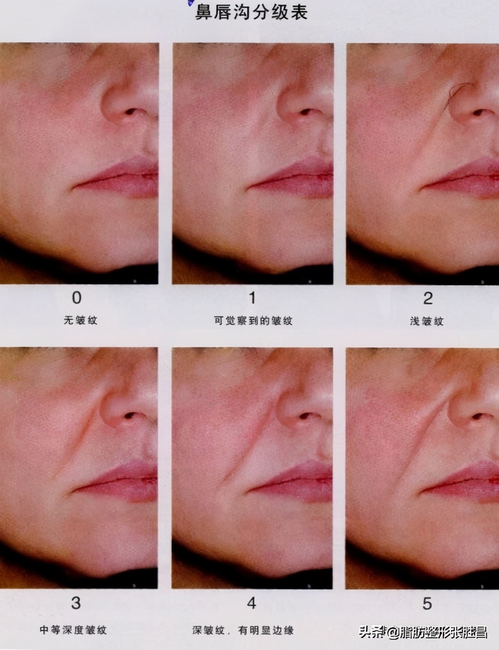 为什么我笑起来有皱纹,为什么我笑起来很显老