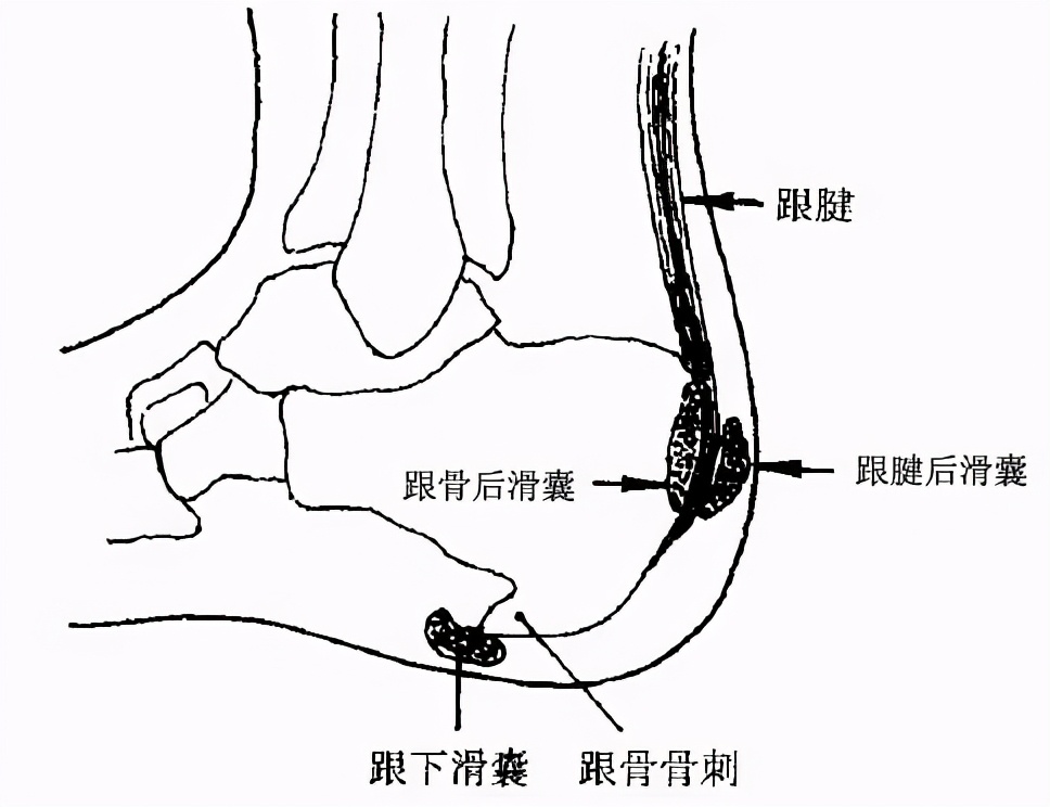 足跟痛做哪个动作能缓解,足跟痛最好的解决方法