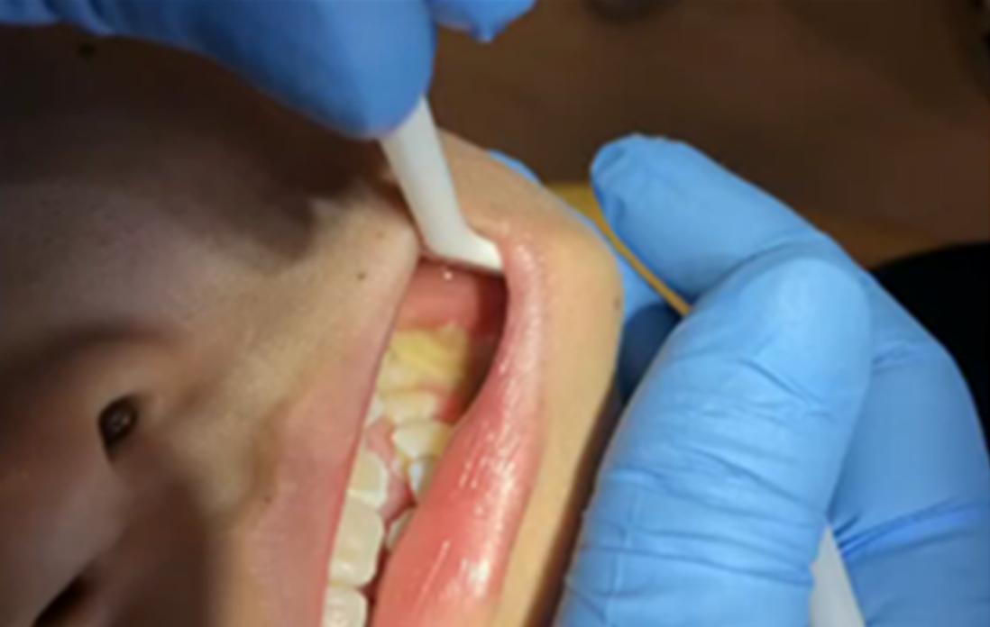 小孩做矫正牙齿痛哭,带孩子医院牙齿矫正刚完事