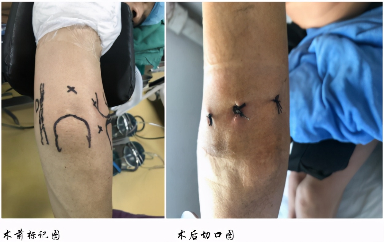 痛风踝关节炎症状,痛风关节炎早发现早治好