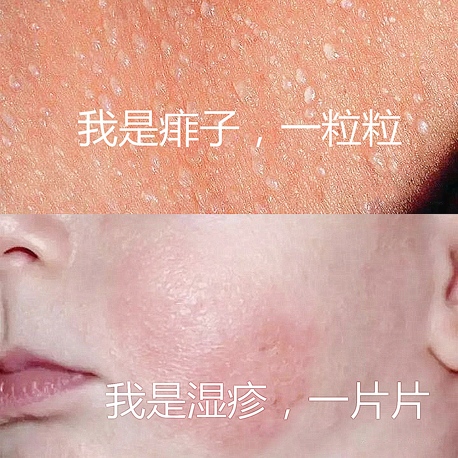 宝宝身上长湿疹还有点红点,小孩身上痱子和湿疹区别