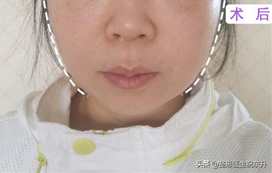 法令纹松弛脸颊下垂怎么填充,用什么来填充法令纹是最好的