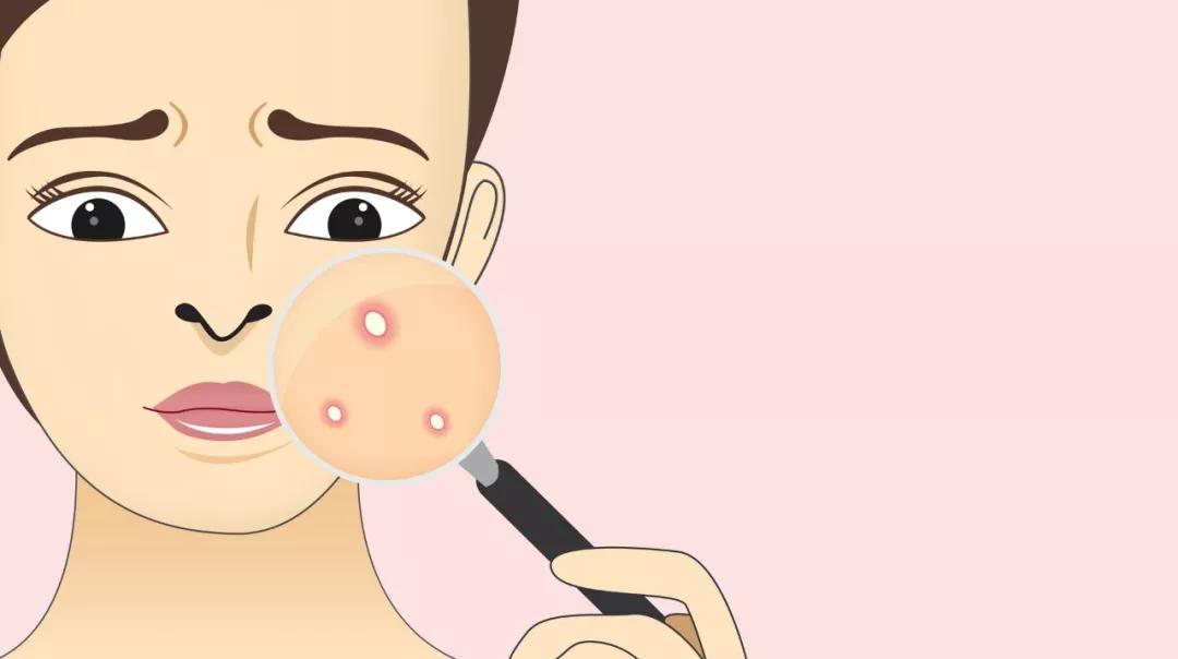 甲硝唑胶囊能治玫瑰痤疮吗,玫芦消痤膏和甲硝唑凝胶区别