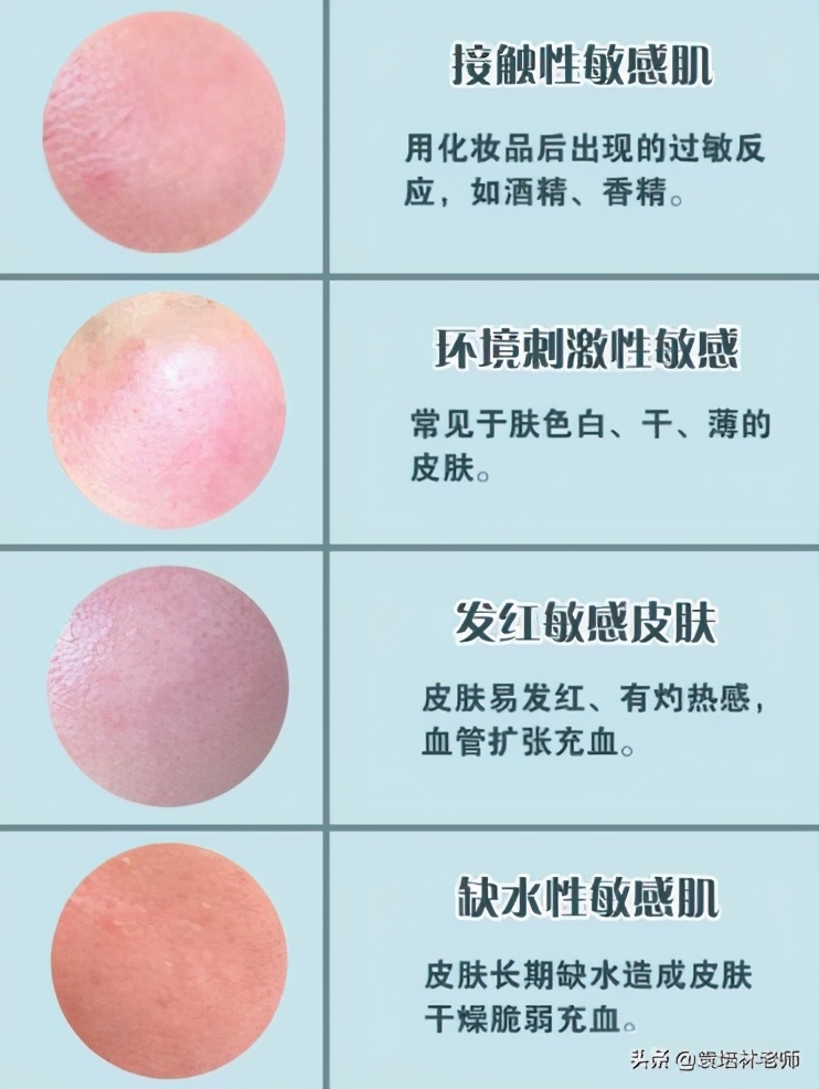 如何修复肌肤屏障油敏肌,油痘敏感肌屏障受损夏天怎么修复