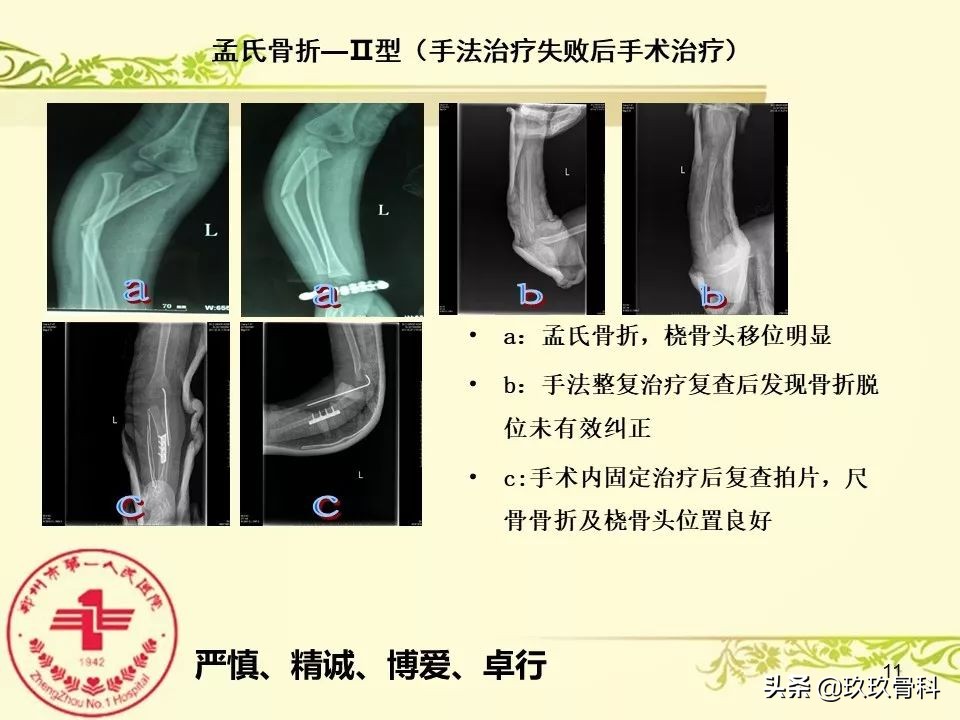 孟氏骨折功能训练多久能恢复正常,孟氏骨折中医能治吗