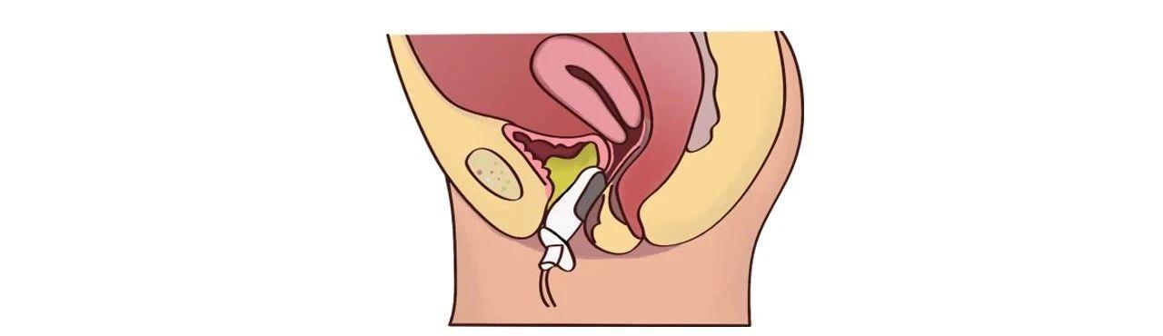 生完孩子三年后盆底肌修复,生完孩子多久做盆底康复合适