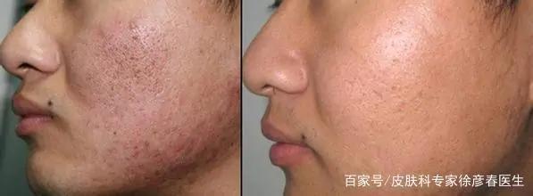 面部生疮后的瘢痕怎么办,疱疹后遗症怎么治