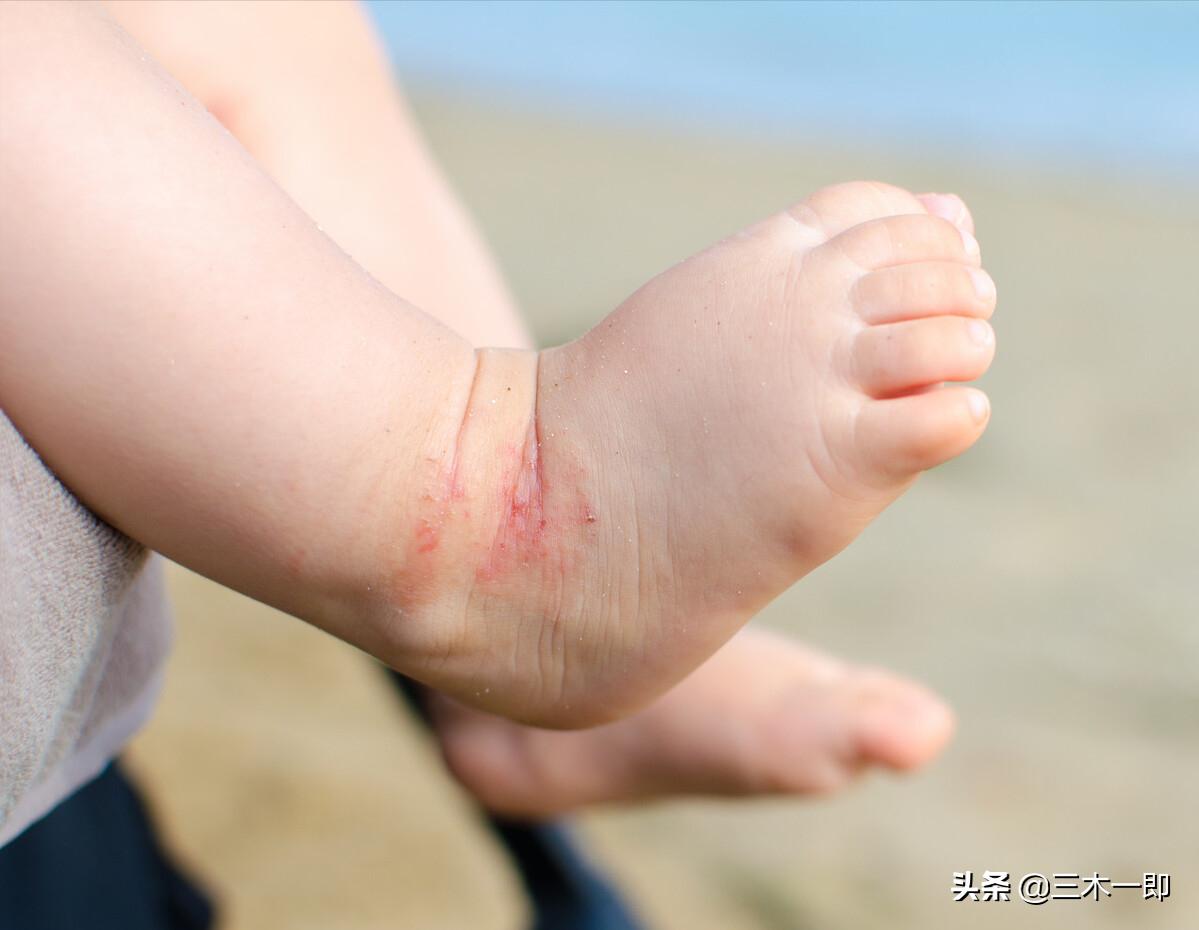 儿童湿疹的治疗做好保湿是关键,湿疹太顽固几招让湿疹不再来