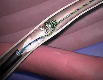 胆结石症状有哪些吃什么药,胆结石有什么症状要吃药吗