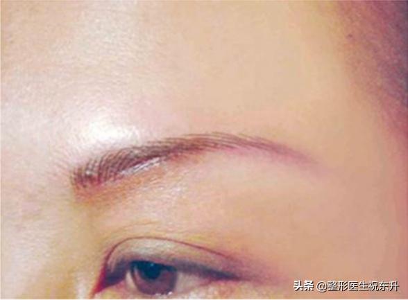 做完提眉术后如何才能不留疤痕,提眉术疤痕明显
