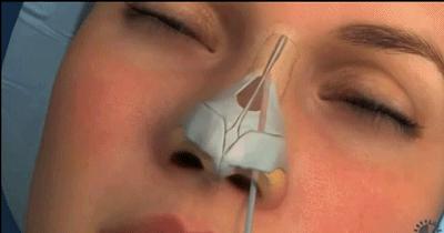 鼻骨太宽是怎样引起的,鼻骨太宽应该如何改善