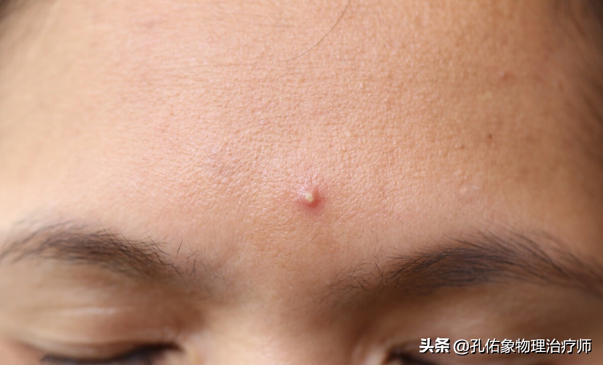 痘痘辟谣,长痘辟谣