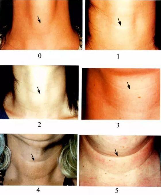 去脖子黑色素颈纹的最快方法,老年人脖子上的颈纹怎么遮挡