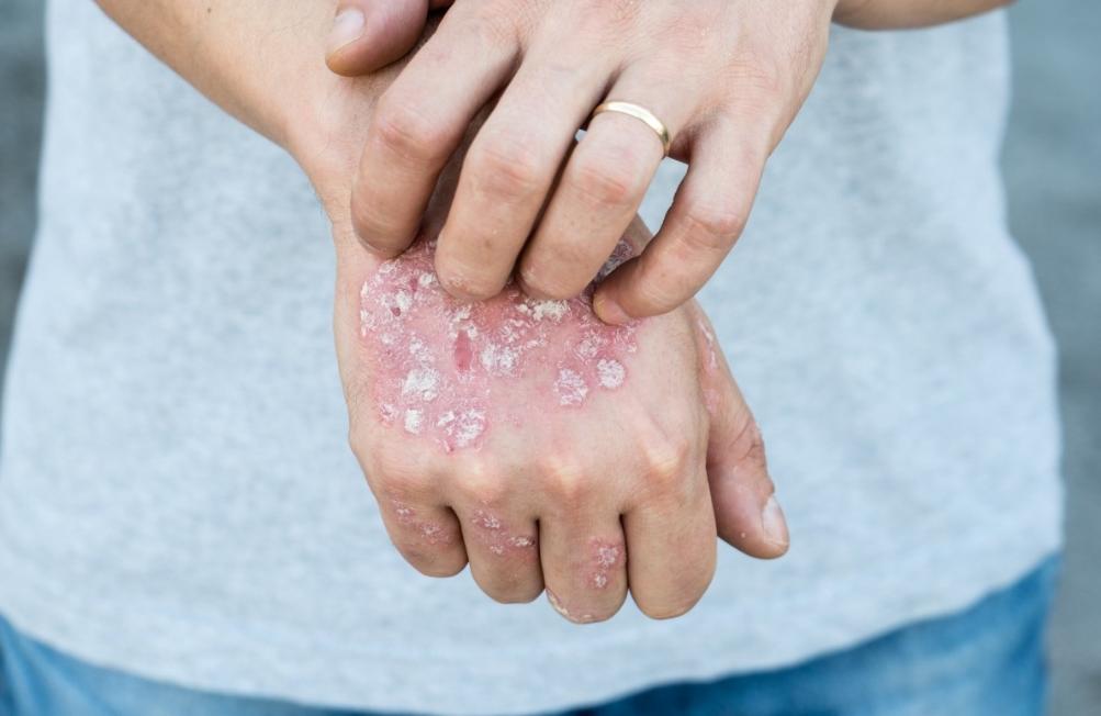 女子腋窝有肿块，怀疑艾滋病，医生一看，竟是患上“猫抓病”