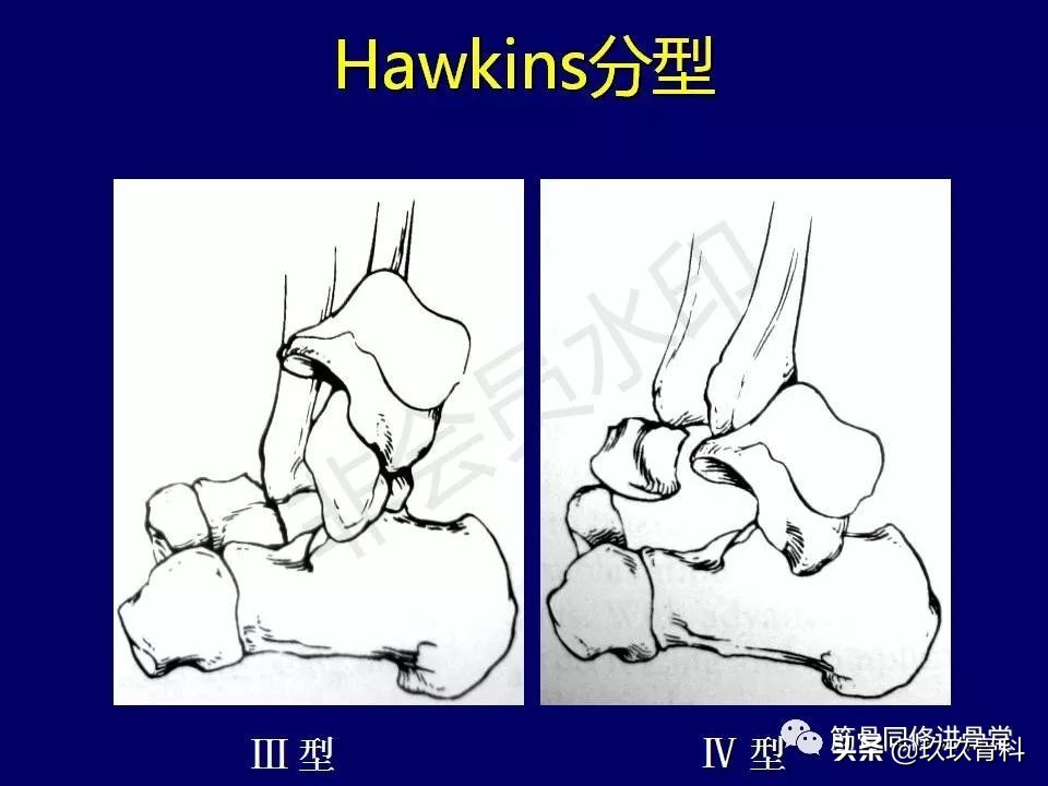 距骨骨折后遗症,距骨骨折怎么办