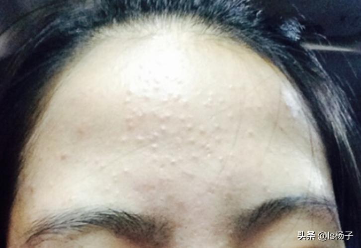 7岁孩子脸上起小米粒疙瘩有白尖,脸上长了好多小白尖的痘痘