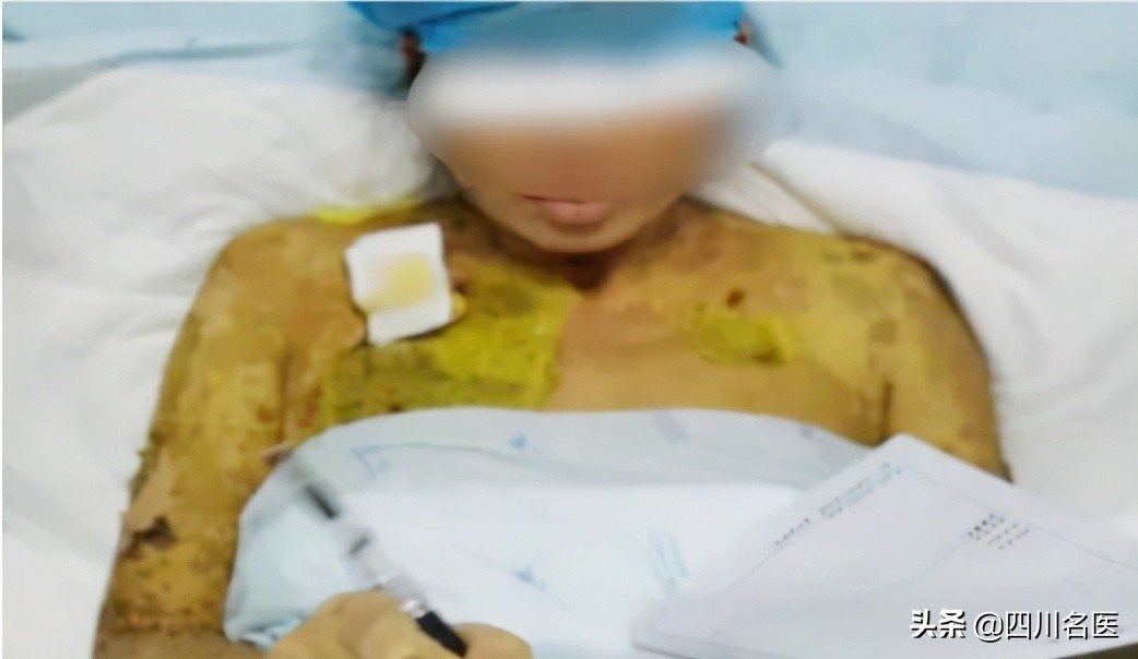 发烧引起皮肤溃烂,发烧过后最里面大面积溃烂