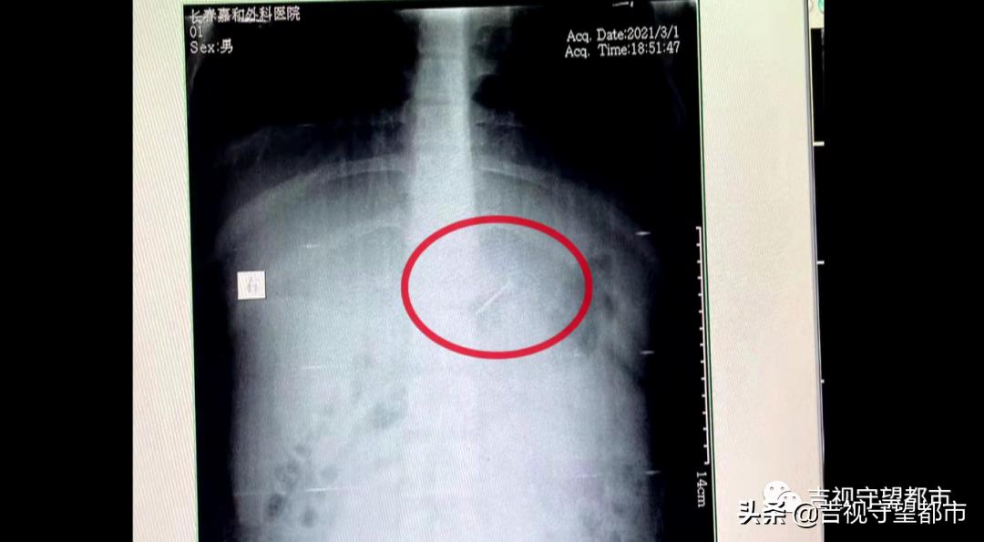 误吞4厘米钢钉,13岁“熊孩子”被紧急送医