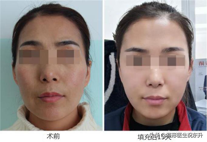 太阳穴凹陷与额头有明显棱角面相,太阳穴凹陷的脸型有长的好看的吗