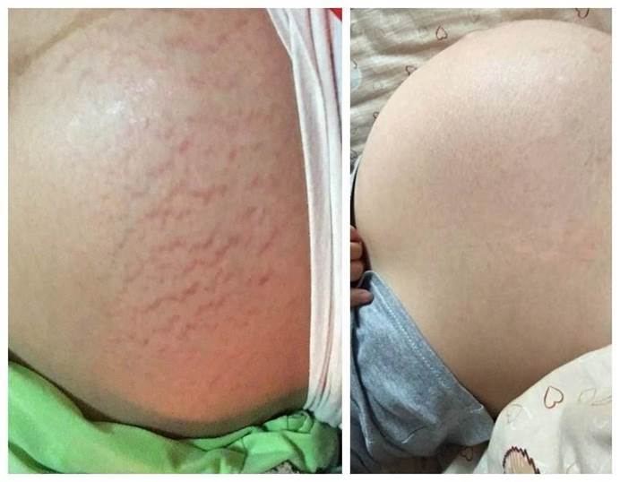 解决孕妇妊娠纹,宝妈们妊娠纹都是怎么去掉的