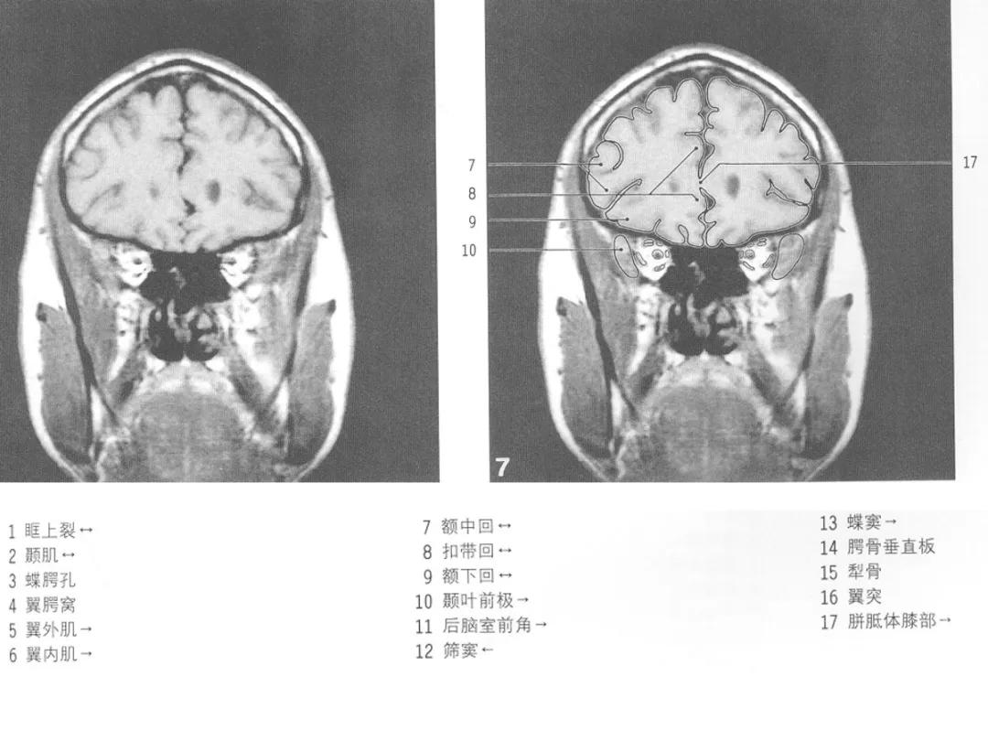 颅脑冠状状切面解剖图,颅脑mr解剖结构图