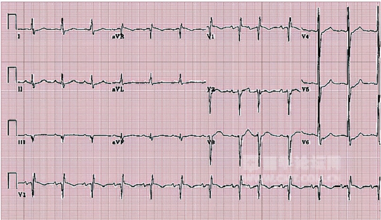 做完搭桥手术后,心绞痛能立即缓解吗?以后还会出现吗?