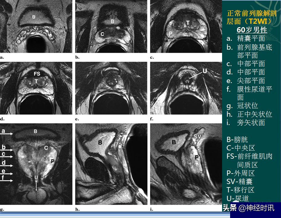 肾脏输尿管膀胱前列腺结构,肾输尿管膀胱解剖示意图