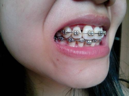 为什么牙齿黑三角不可逆,黑三角是不可逆的吗